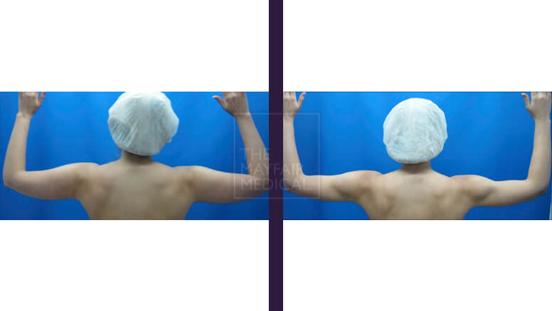 arm lift-before and after 3