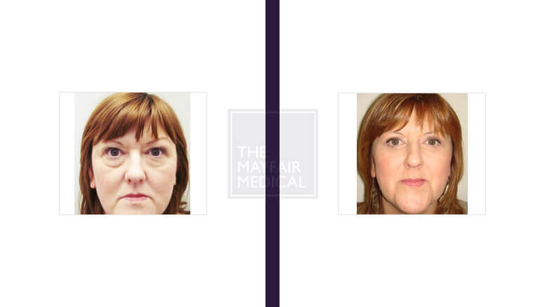 blepharoplasty - before and after 1