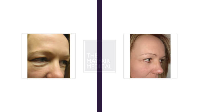 blepharoplasty - before and after 2