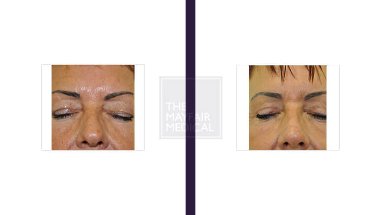 blepharoplasty - before and after 3