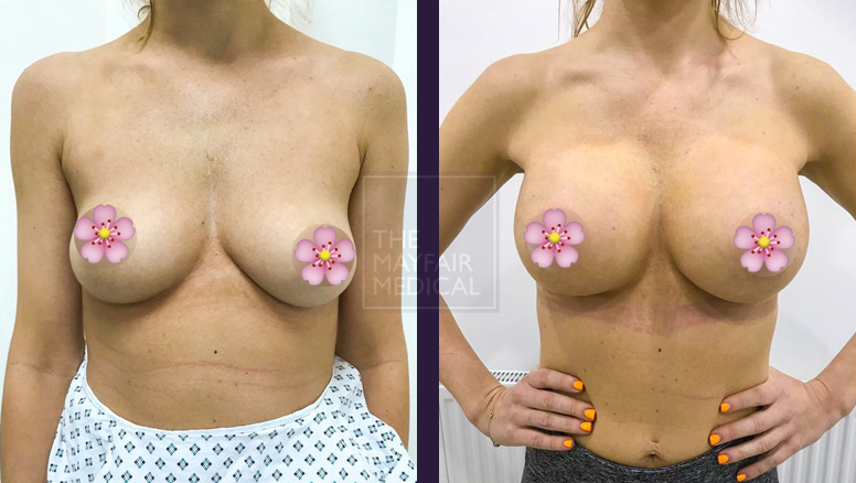 breast augmentation-before and after 1