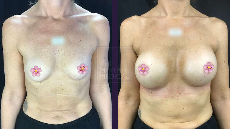 breast augmentation-before and after 3
