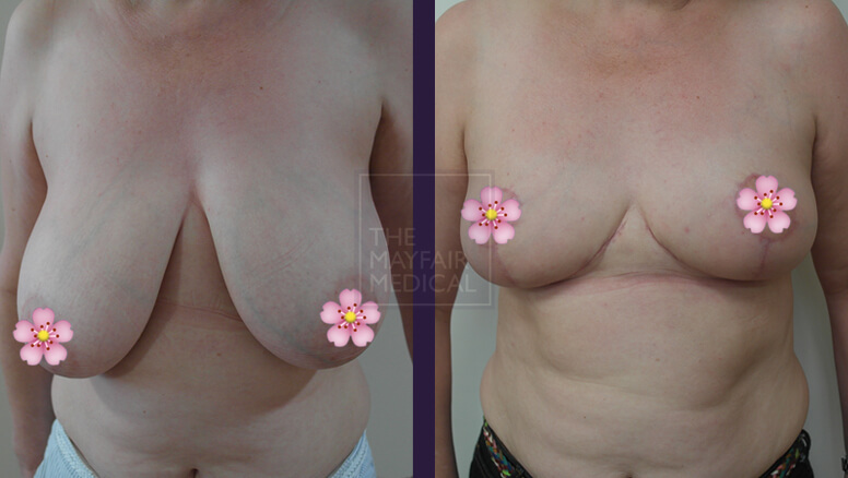 breast reduction-before and after
