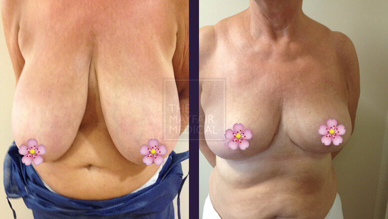 breast reduction-before and after 3
