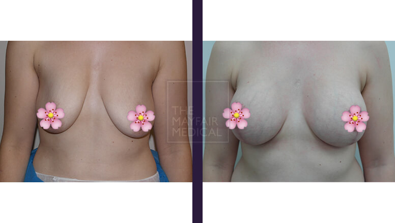 breast uplift before and after - 1