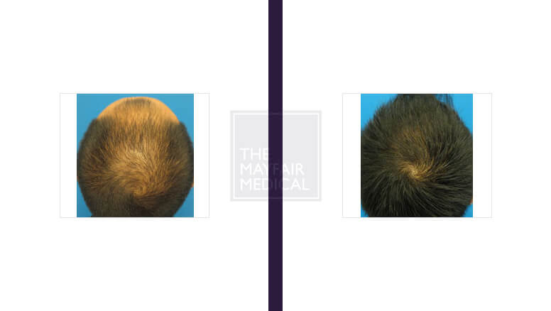 hair transplant-before and after