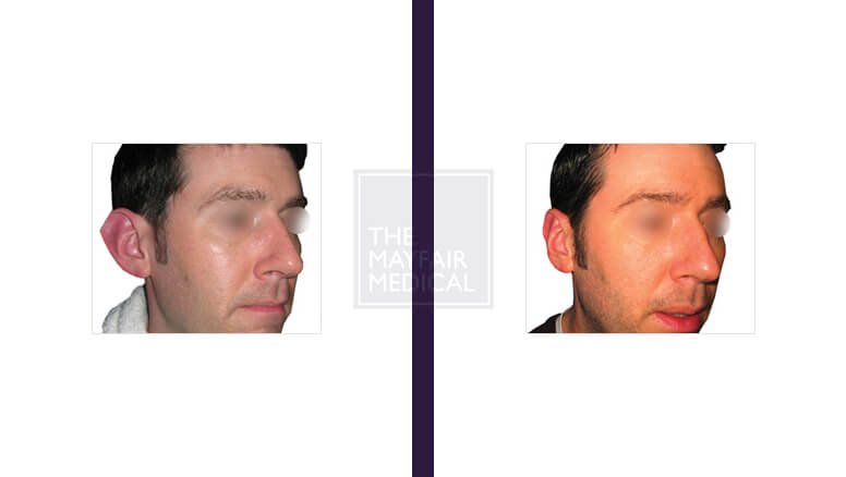 otoplasty-before and after 1