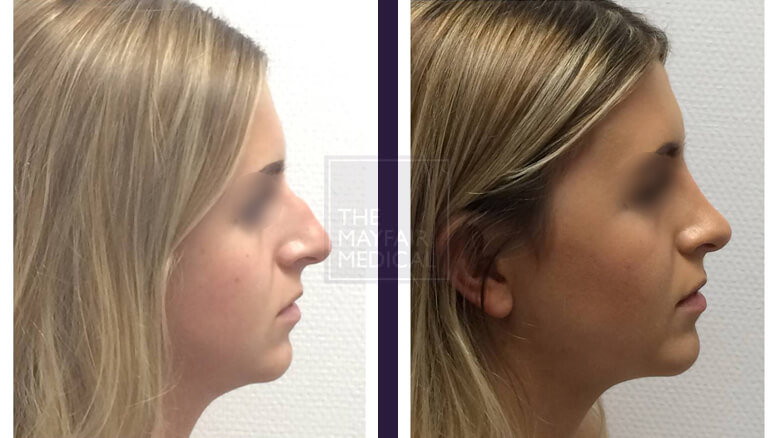 rhinoplasty-before and after 1