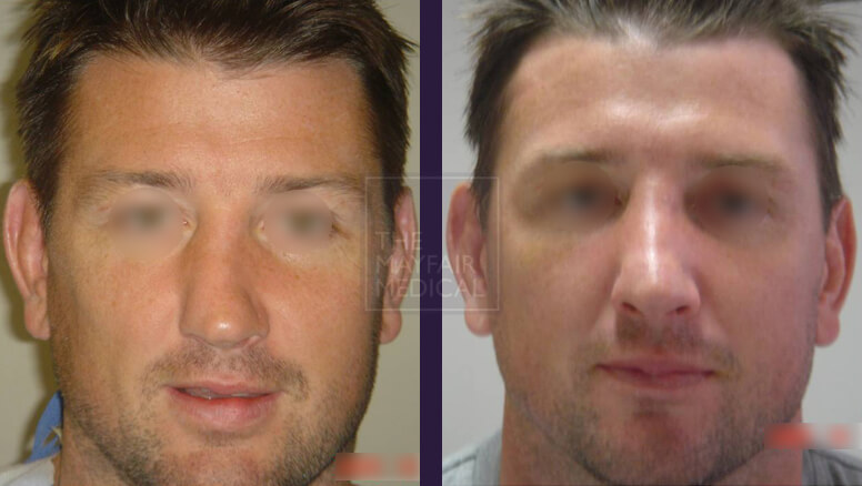 rhinoplasty-before and after 3