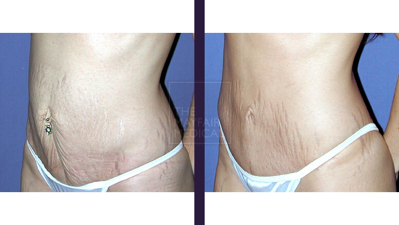 tummy tuck - before and after 2