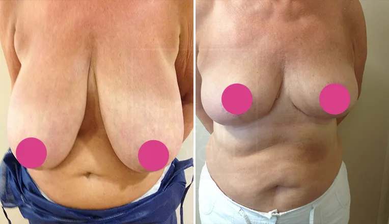 before and after breast reduction