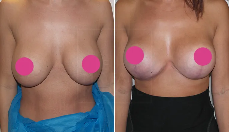 breast uplift before and after patient-3