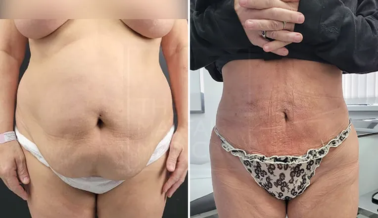 stomach liposuction before and after